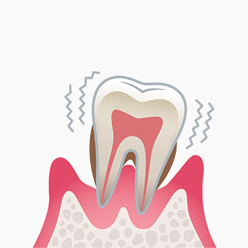歯周炎（重度）